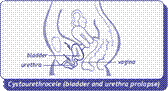 diagram of cystourethrocele